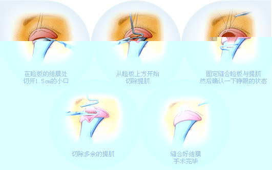 上睑下垂_广州华美医疗美容医院